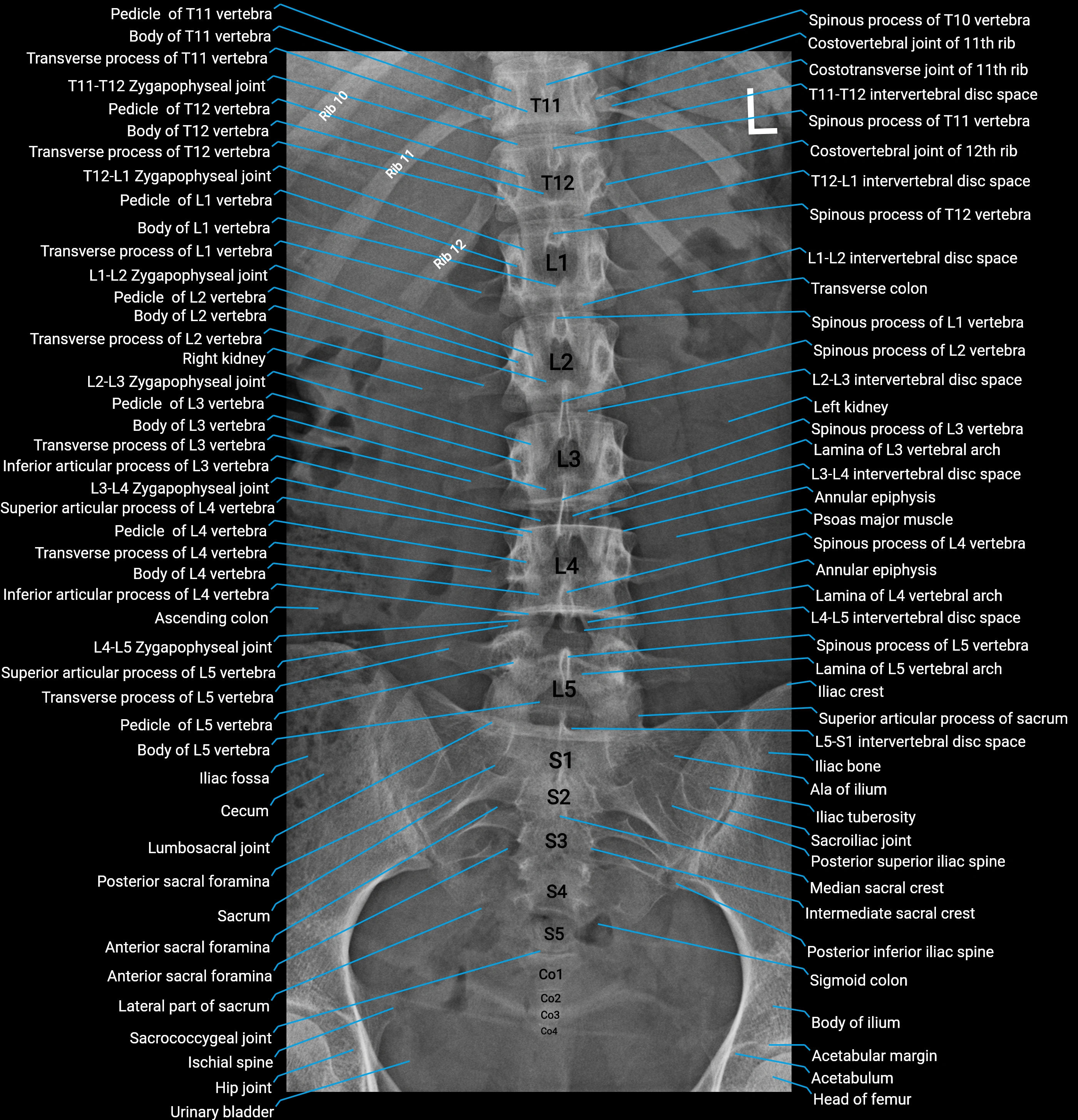 X Ray L Spine AP anatomy.webp